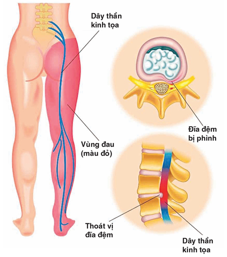 Các thuốc điều trị đau dây thần kinh tọa
