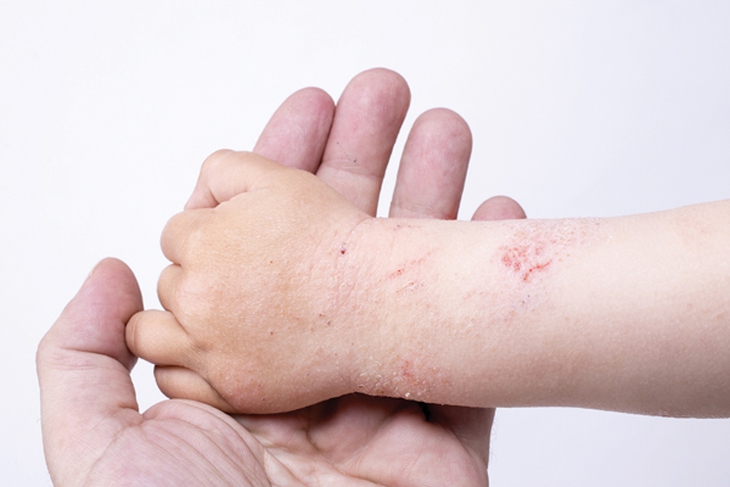 Viêm da cơ địa, bệnh mạn tính dễ tái phát