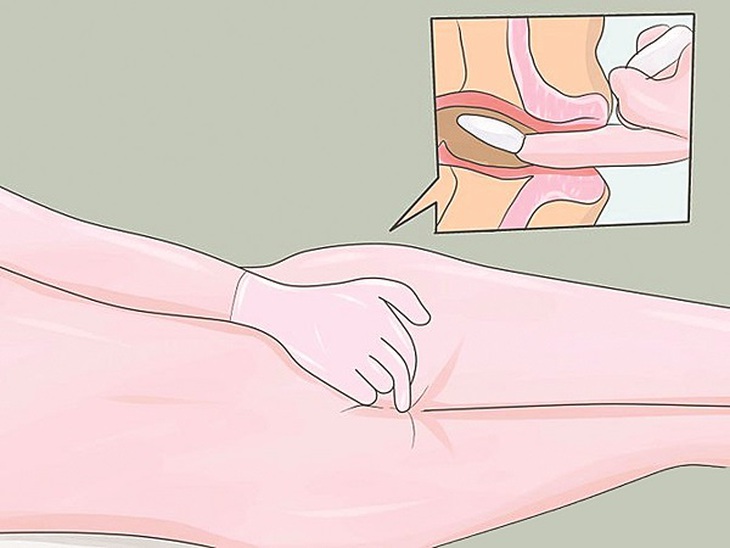 Sử dụng đúng dạng thuốc đặt hậu môn