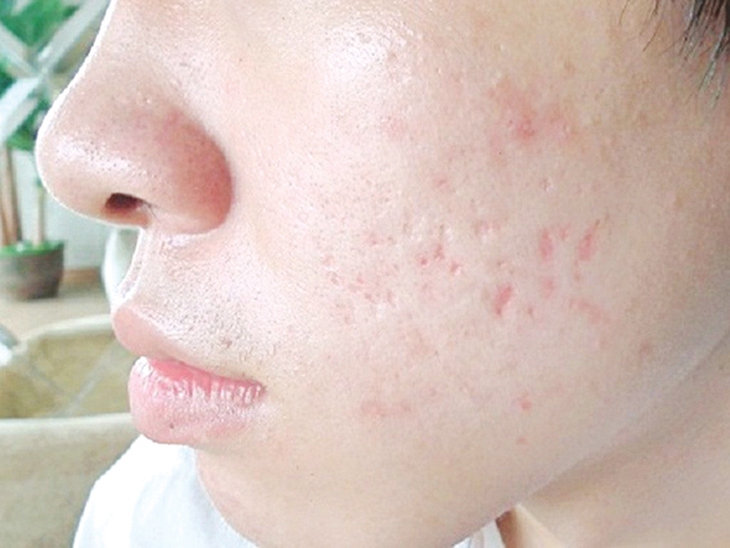 Xóa sẹo rỗ do mụn