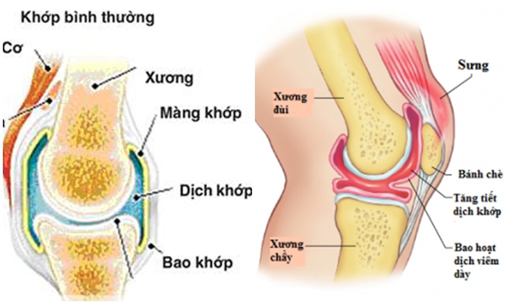 Trị đau khớp gối 