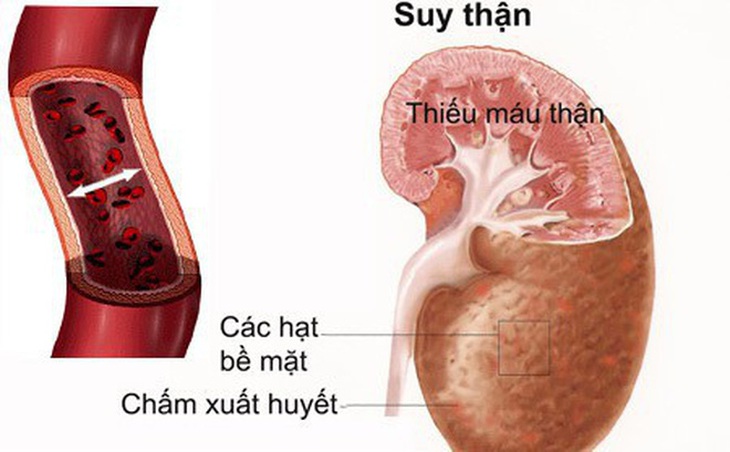 Phòng ngừa và điều trị bệnh lao thận hiệu quả
