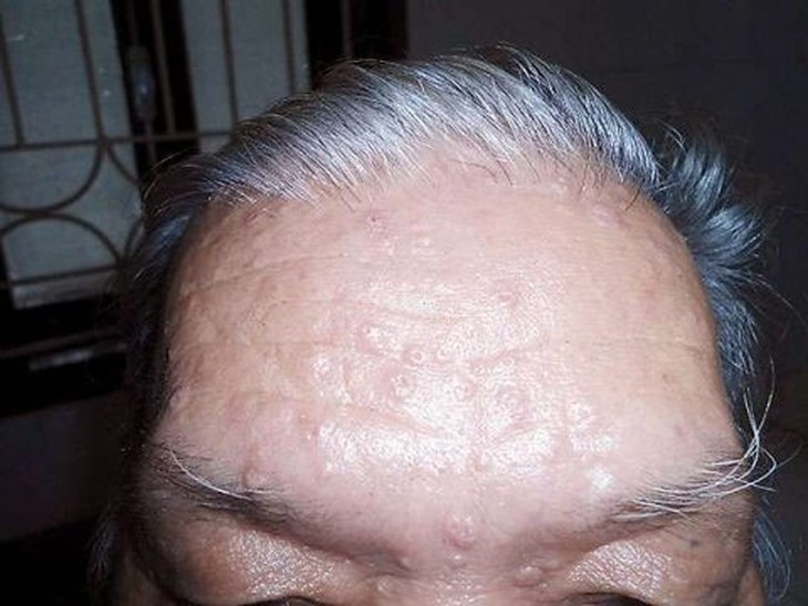 Hiểu đúng về bệnh hạt kê