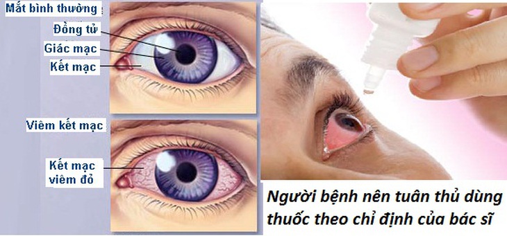 Lựa chọn thuốc trị viêm kết mạc dị ứng