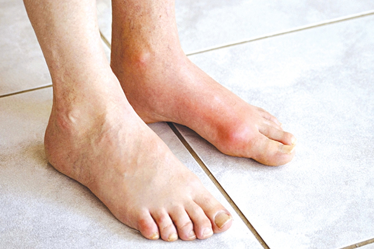Chớ chủ quan với bệnh gout