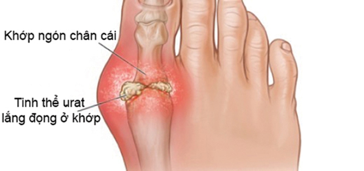 Chớ chủ quan với bệnh gout