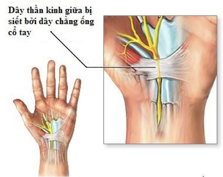 Tê tay khi ngủ 