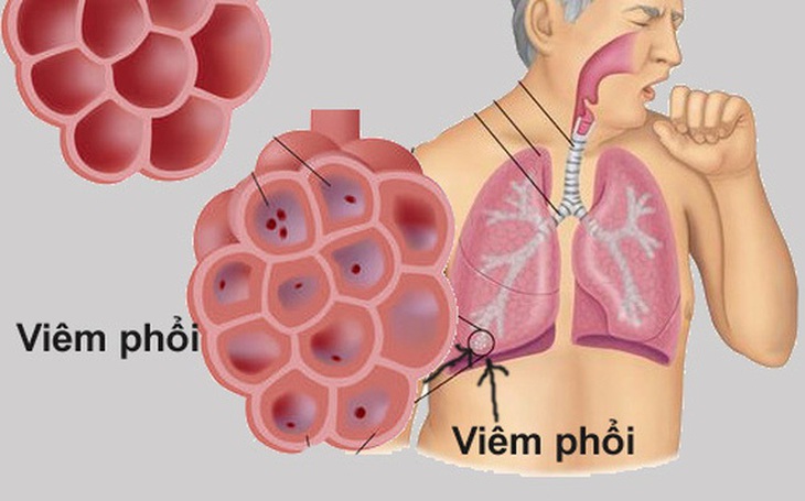 Các bệnh phổi do Lupus ban đỏ