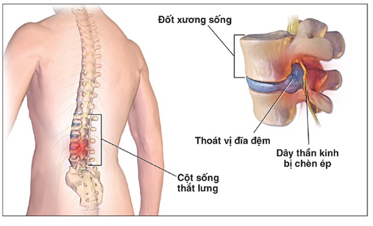 Người thoát vị  đĩa đệm tự ý dùng thuốc giảm đau