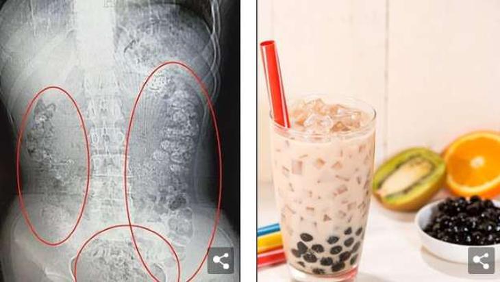 100 hạt trân châu mắc kẹt trong bụng bé gái