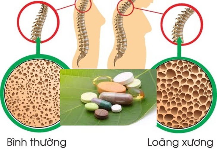 Lưu ý cần thiết khi dùng thuốc trị loãng xương