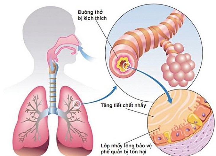 Tránh các biến chứng bệnh COPD trong mùa nóng