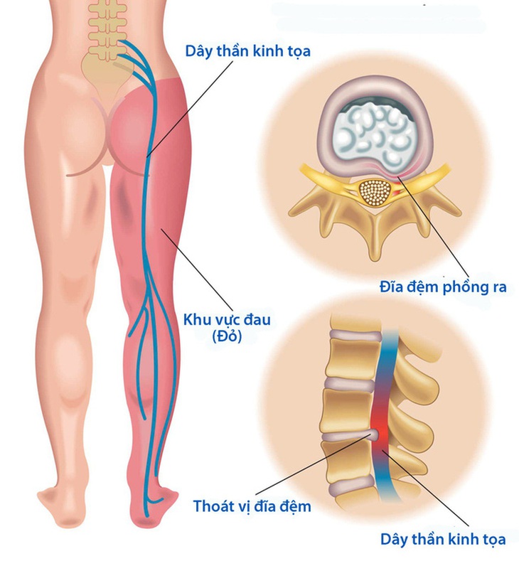 Đau thần kinh tọa có thể gây tàn phế...