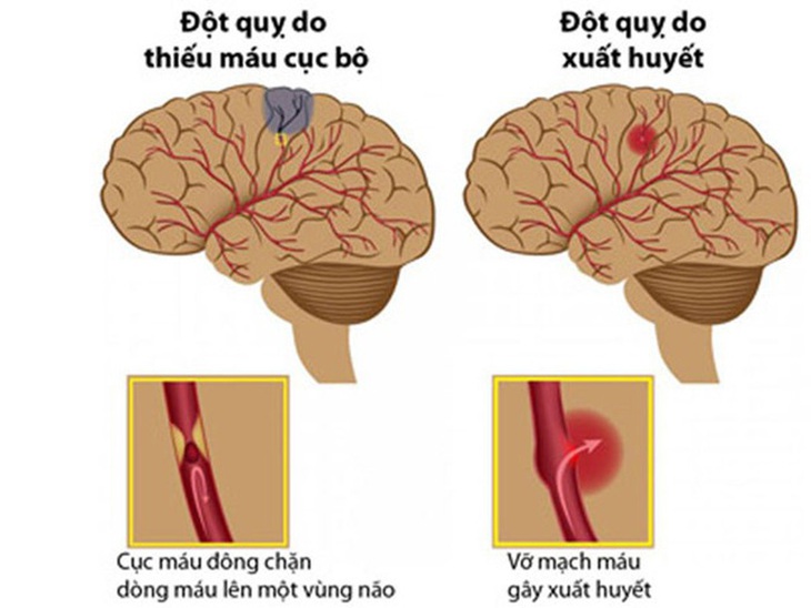 Yếu, liệt nửa người