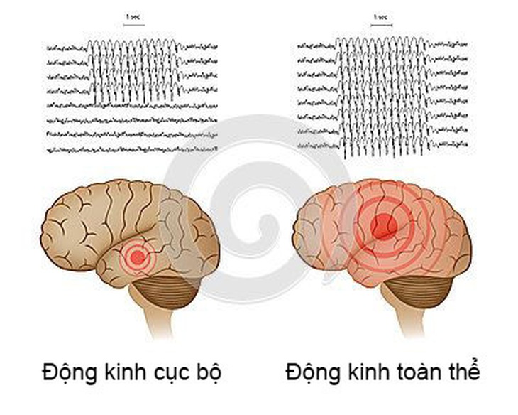 Xử trí đúng cách khi lên cơn động kinh