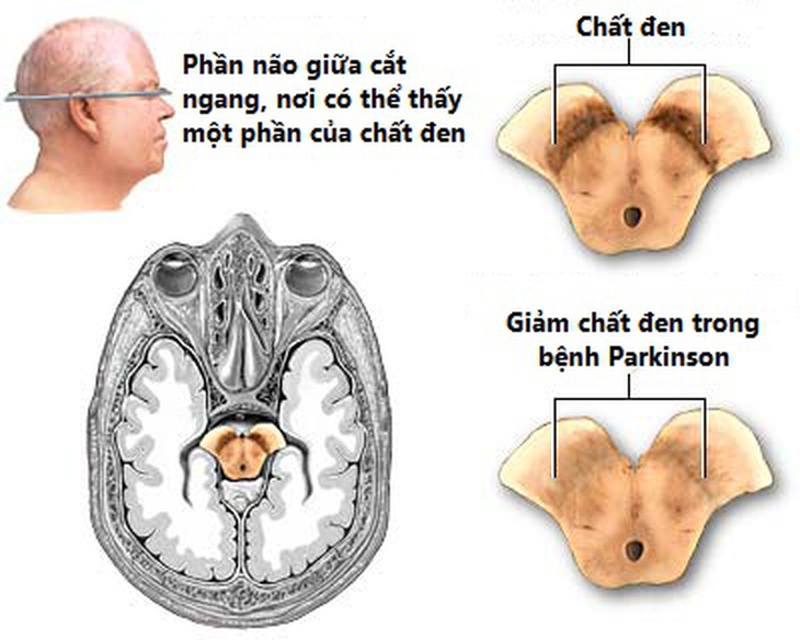 Giảm nhẹ ảnh hưởng của bệnh Parkinson