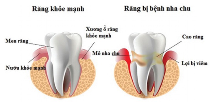 Viêm nha chu 