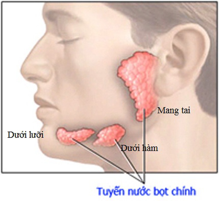 Vôi hóa tuyến nước bọt 