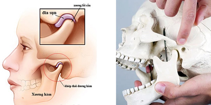 Rối loạn khớp thái dương hàm