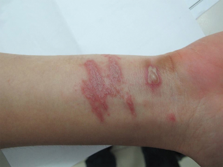 Mùa mưa: Coi chừng  viêm da do kiến ba khoang