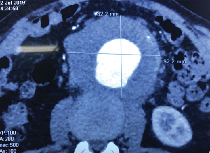 Phình động mạch