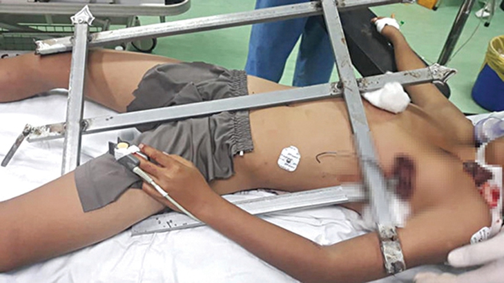 Những ca dị vật đâm xuyên cơ thể được cứu sống ngoạn mục