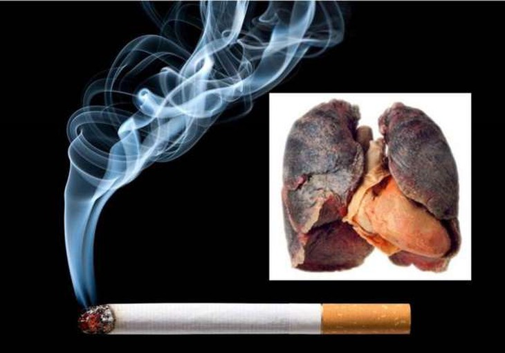 Nguy cơ ung thư phổi từ bệnh COPD