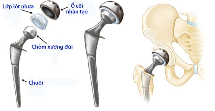 Ðiều cần biết về thay khớp háng