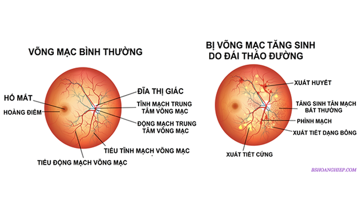 Phòng ngừa biến chứng do đái tháo đường type 1