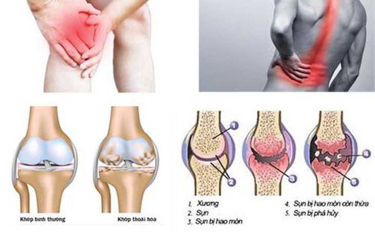 Bài thuốc trị đau mỏi các khớp