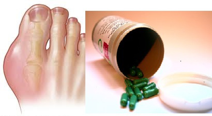 Ðiều cần lưu ý khi dùng các thuốc hạ acid uric máu