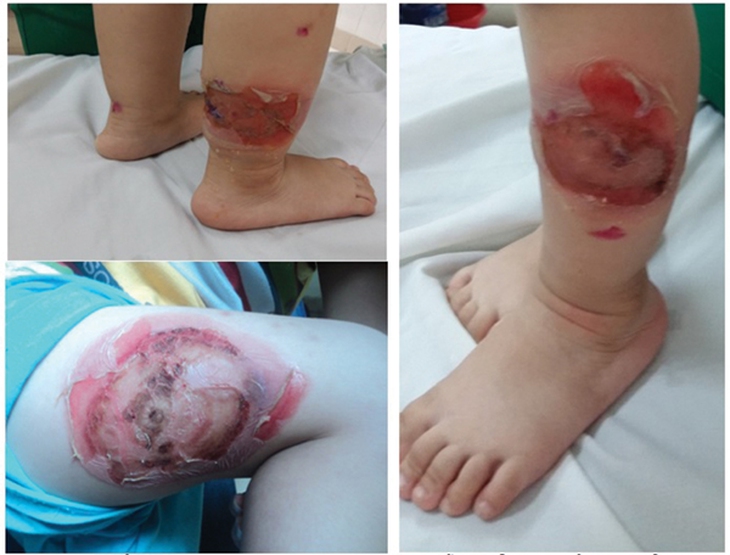 Đừng để bệnh chốc ghẻ làm hỏng da trẻ