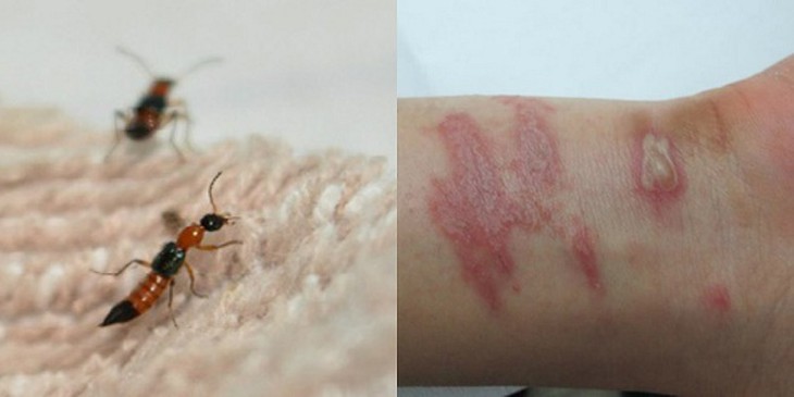 bệnh vảy nến