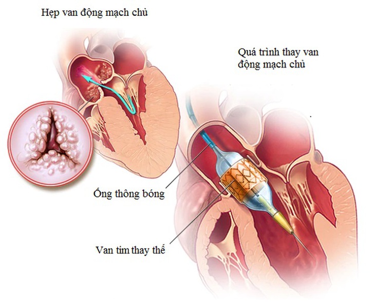 Một số kỹ thuật trong tim mạch can thiệp