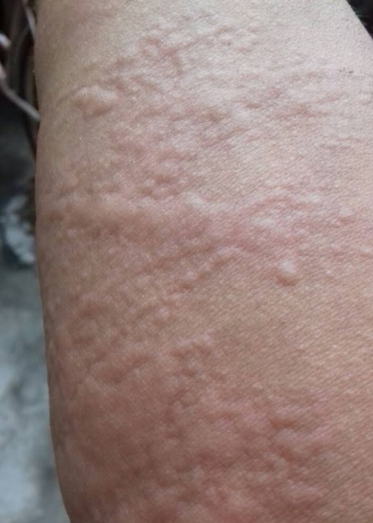 Thuốc trị mề đay ở trẻ em