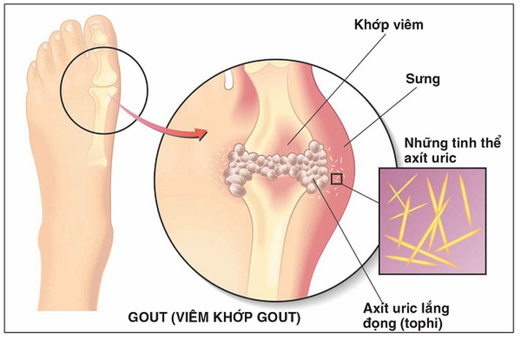 Cách kiểm soát axit uric tăng cao