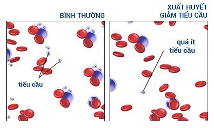 Sốt xuất huyết, tiểu cầu giảm