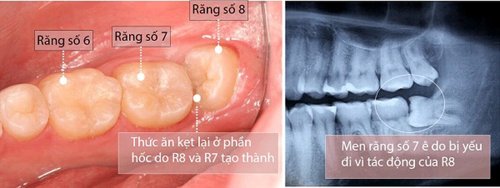 Răng số 8 mọc lệch không đau có cần nhổ?- Ảnh 1.