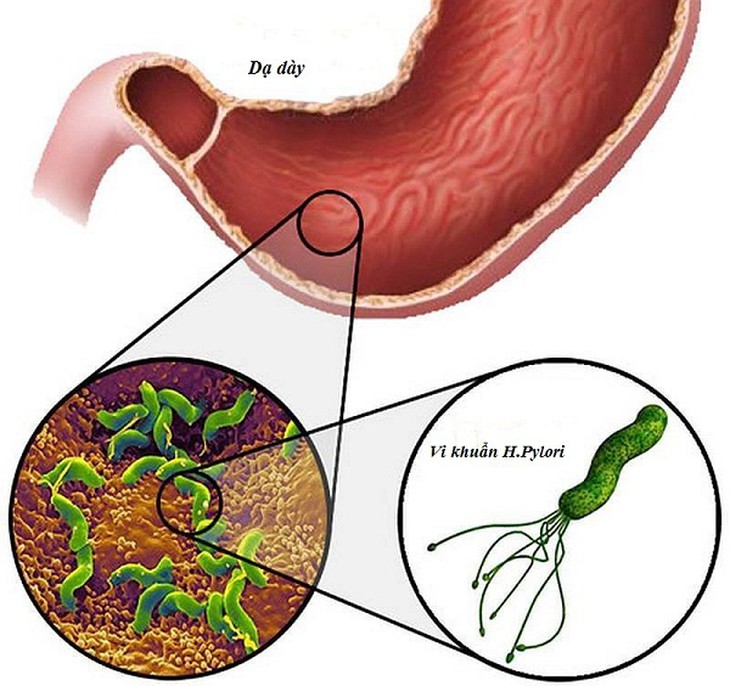 Dùng thuốc đúng cách trị viêm loét dạ dày do H.pylori