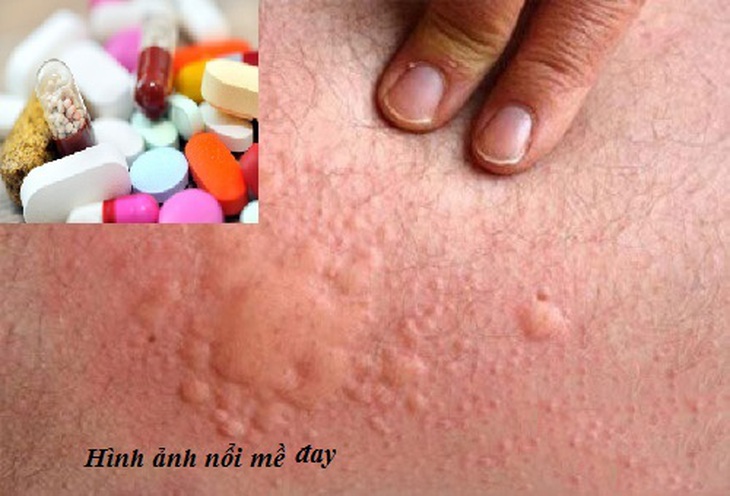 Lưu ý khi dùng thuốc kháng histamin H1 trị dị ứng