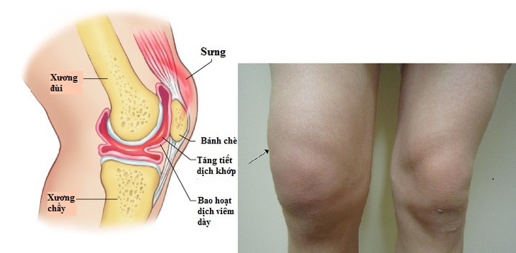 Viêm điểm bám gân và tràn dịch khớp có nguy hiểm?