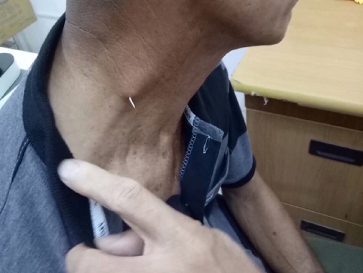 Hóc xương