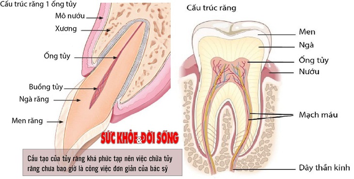 Lấy tủy về răng rất đau