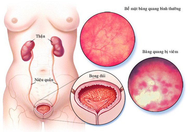 Đau vùng chậu mạn tính