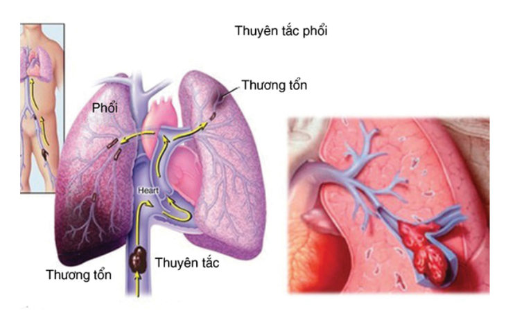 huyết khối tĩnh mạch sâu chi dưới