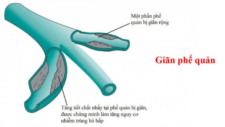 Giãn phế quản