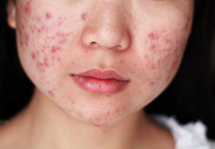 Làm gì để cải thiện trứng cá của tuổi dậy thì?