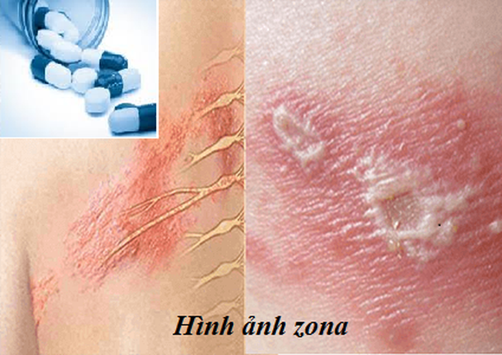 Trị bệnh zona, dùng thuốc kháng virus thế nào?