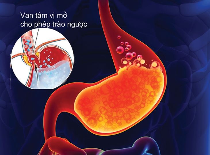 Những lưu ý khi bị trào ngược dạ dày - thực quản