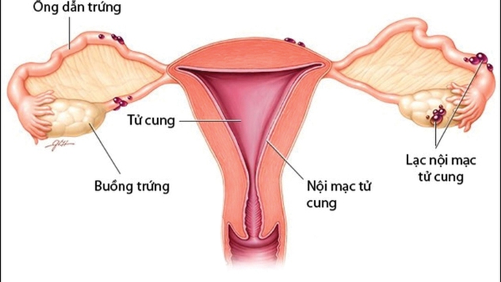 5 bệnh ở tử cung dẫn đến vô sinh